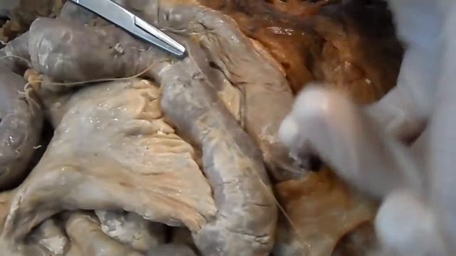 Шов Ламбера серозно-мышечный смотреть онлайн