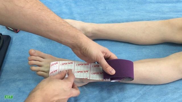 ✅ Боль в стопе. Как с помощью тейпирования помочь пациенту? смотреть онлайн