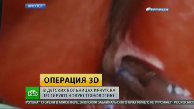 Иркутские хирурги оперируют с помощью 3D технологий