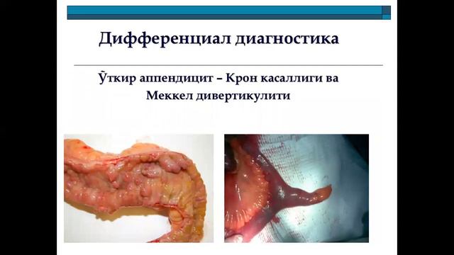 Ўткир аппендицит ва унинг асоратлари смотреть онлайн