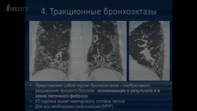 Дифференциальный диагноз феномена «сотового легкого» смотреть онлайн
