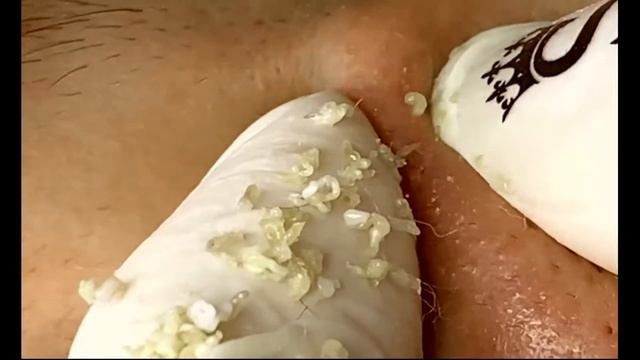 Blackhead Removal New - Blackhead Extraction  -спокаивающее расслабление, удаление черных точек