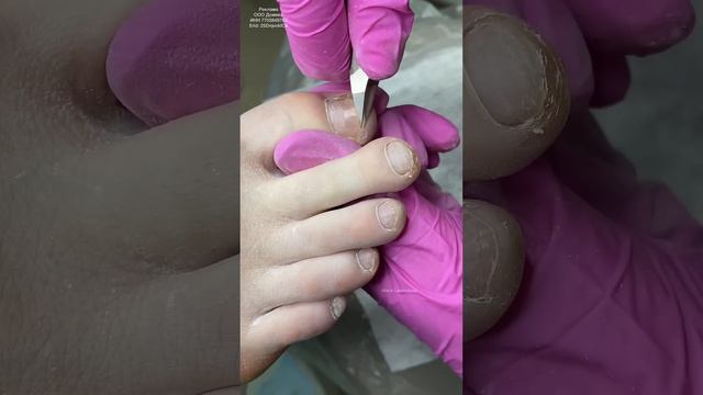 ПОТНЫЕ НОГИ 🦶🏻😖 #аленалаврентьева #ногти #shortsvideo #педикюр #подология #подологказань #потныеног смотреть онлайн