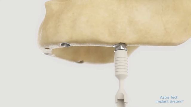 SmartFix® concept for Astra Tech Implant System® EV Dentsply смотреть онлайн