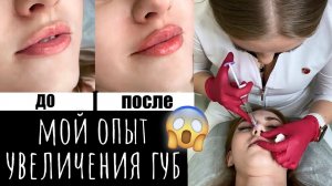 ПЕРВОЕ УВЕЛИЧЕНИЕ ГУБ ДО И ПОСЛЕ ? Это нужно знать КАЖДОЙ ❗️ Что со мной сделали?