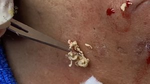 Acne Treament Under The Skin #061