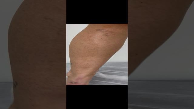 Склеротерапия, подготовка. Удаление сосудистой сетки. Лечение варикоза. Лечение вен. Флеболог Москва смотреть онлайн