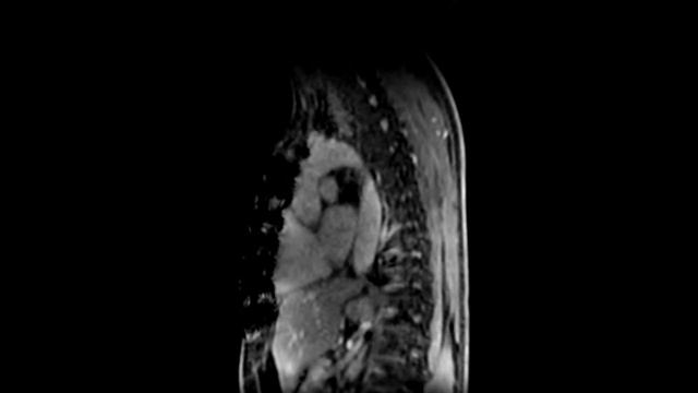 High resolution 3D T1 lung MRI at 3 Tesla смотреть онлайн