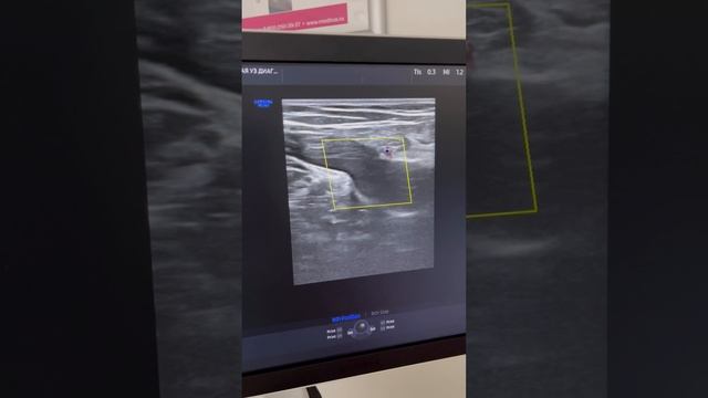 Варикоз у парня 30+ лет. Узи вен. Варикоз на узи. Лечение варикоза. Флеболог. Флеболог Москва смотреть онлайн