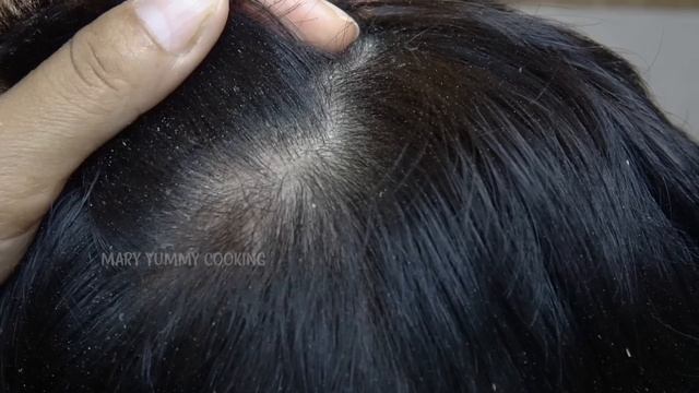 Scratching Dry Itchy Scalp!! Dandruff Removal Satisfying #360