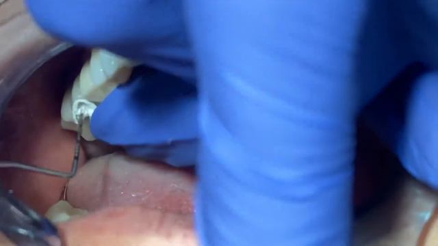 Steps by steps to deliver an implant crown смотреть онлайн