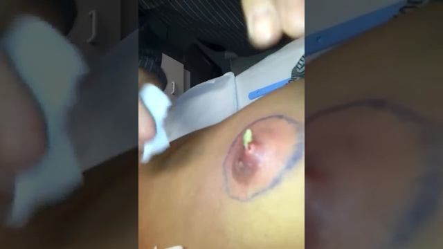 Keegan's Pus Exploding Nipple смотреть онлайн