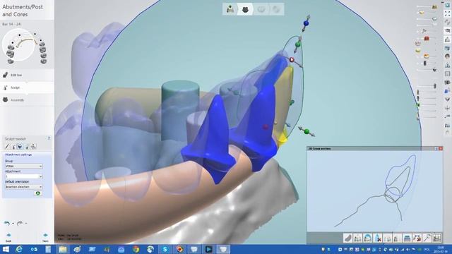 Design superstructure in Dental System - part 2 смотреть онлайн