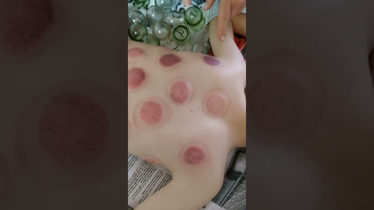 СТЕКЛЯНЫЕ БАНКИ НА СПИНУ. #банки #бронхит смотреть онлайн