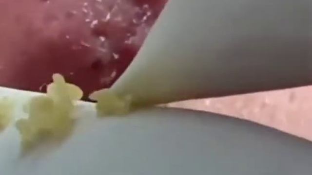 КОМЕДОНЫ НА НОСУ/comedos Are On Their Nose