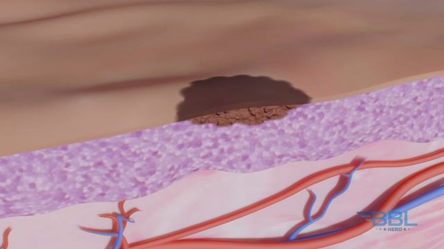 Sciton BBL HERO RU 2 1