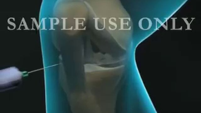 Torn Knee Meniscus Repair смотреть онлайн