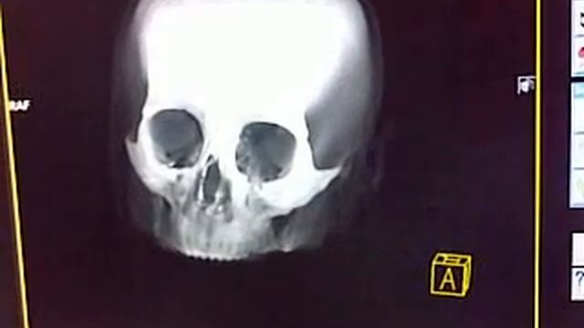 Череп КТ часть 5 skull CT part 5 смотреть онлайн
