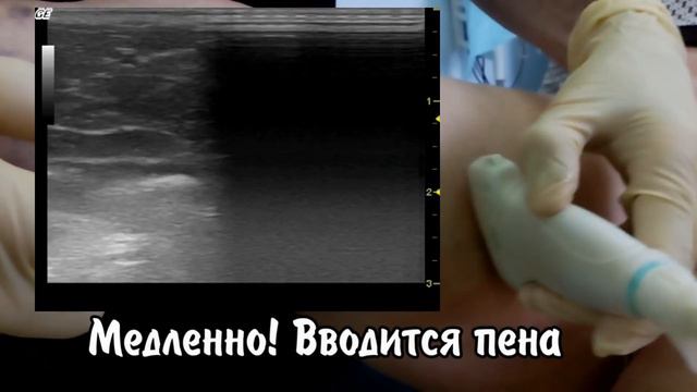 Стволовая склеротерапия большой подкожной вены смотреть онлайн