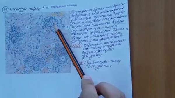 17 микропрепарат. Некрозды нефроз/Некрозный нефроз