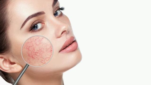 Маска для лица от сосудистых звездочек! смотреть онлайн