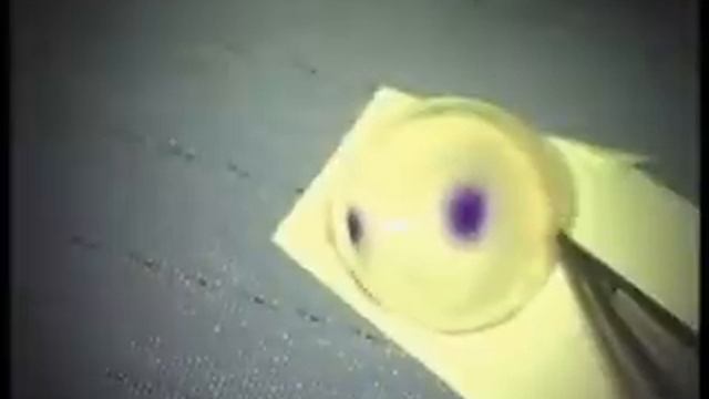 Posteriore lamelläre Keratoplastik смотреть онлайн