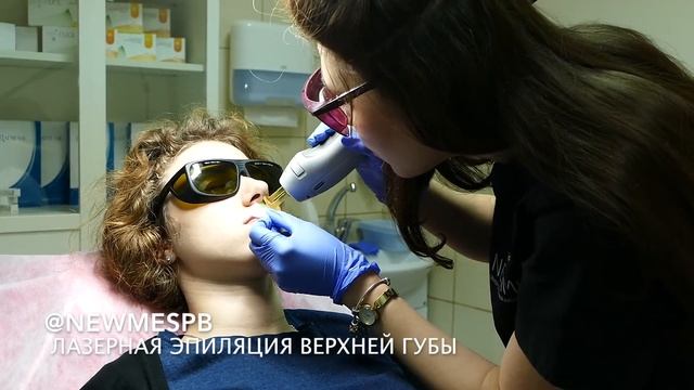 Лазерная эпиляция верхней губы с помощью александритового лазера CANDELA GENTLELASE PRO смотреть онлайн