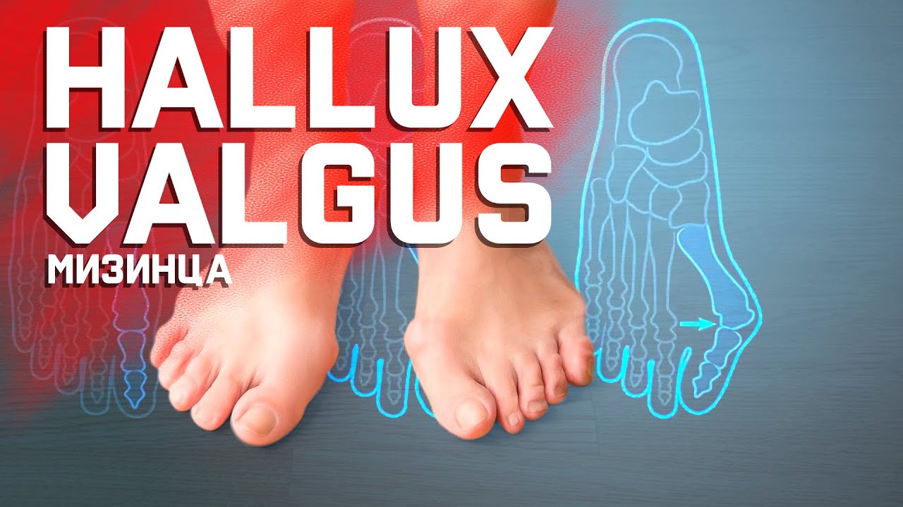 Hallux Valgus мизинца. Что с ним делать? смотреть онлайн