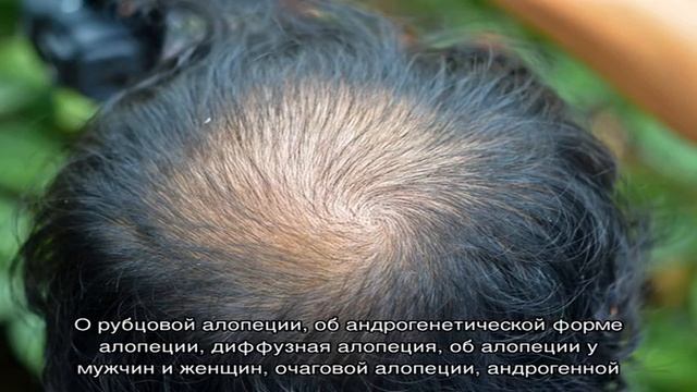 БОЛЕЗНИ ВОЛОС