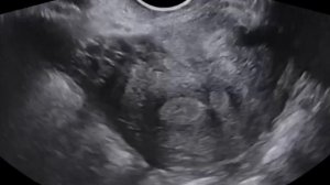 УЗИ матки. Синехия в полости матки.  Ultrasound of utery. Synechia.