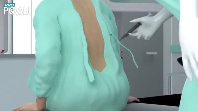Кесарево сечение 3D анимация смотреть онлайн