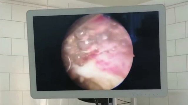 HRS myomectomy FIGO I diameter 2.8 cm. Гистерорезектоскопия. Миомэктомия. смотреть онлайн