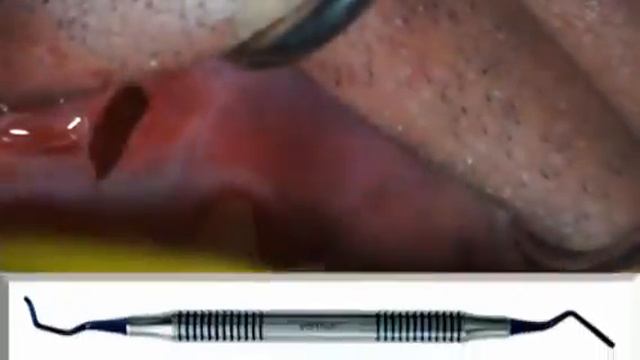 Лечение рецессий с помощью техники VISTA смотреть онлайн