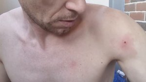 Клещ. Рана гниёт. Голову клеща вынимаем ножом.