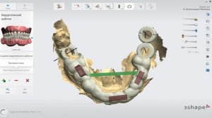 Хирургический шаблон в 3Shape