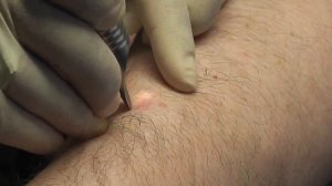 Как происходит удаление шрамов (рубцов) лазером?