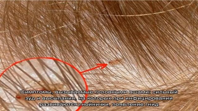 Как избавиться от вшей и гнид с помощью дегтярного мыла смотреть онлайн