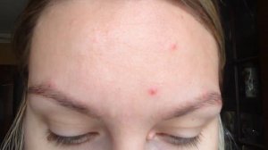 Алергия на краску хну и татуаж! Как избавится от аллергии за неделю!