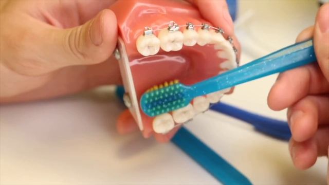Как чистить зубы с брекетами? Рассказывает и показывает стоматолог Никита Александрович Дроздецкий смотреть онлайн