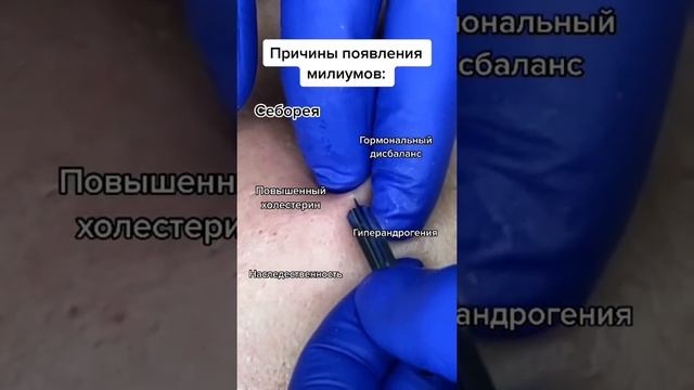 Удаление черных точек Большие кистозные прыщи Удаление черных точек Удаление прыщей смотреть онлайн
