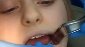 удаление молочного зуба СМАЙЛиК