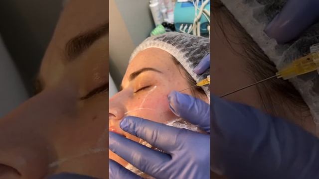 Контурная пластика канюлей-голивудские скулы!!! смотреть онлайн