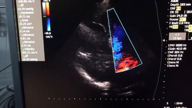 ТЕЛА, тромбы правого предсердия, тромбоз вен голени