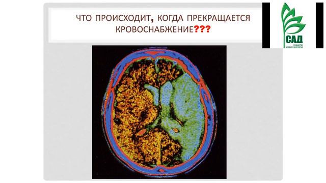 ACLON Н. Шабанова. Сосуды головного мозга. 09.01.2018 смотреть онлайн