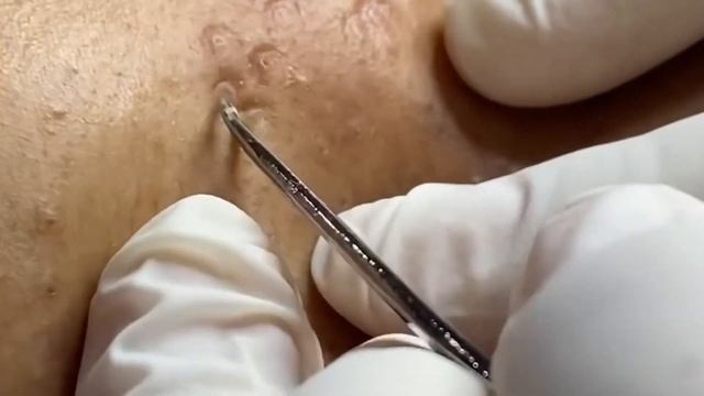 This Pimple Popping Method Will Leave You Speechless! Part 2