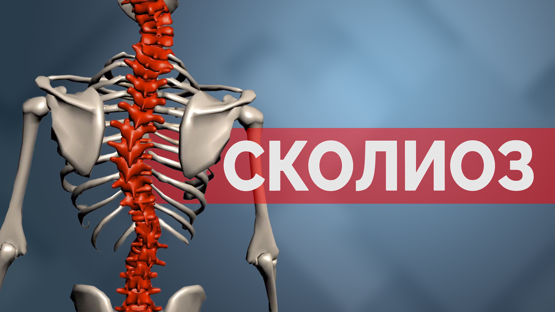 Сколиоз. Что это? Как протестировать? смотреть онлайн