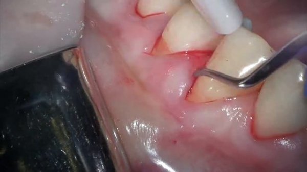 Рецессия десны