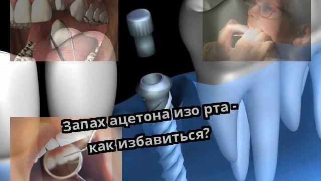 Запах ацетона изо рта - как избавиться? смотреть онлайн