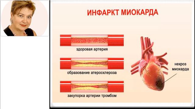 Эраконд и риски инфарктов смотреть онлайн
