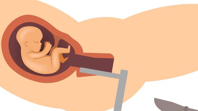D&E Abortion (Dilation and Evacuation) смотреть онлайн
